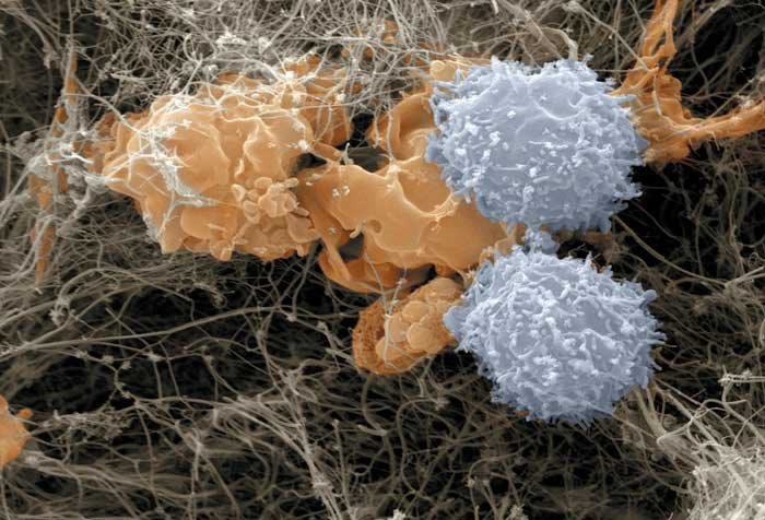 whitebloodcellsattackingcancercells